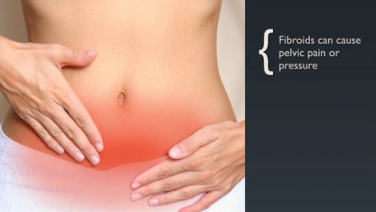 Fibroids courtesy of gigarelifestyle-com