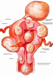 Fibroids courtesy of wdavidstinsonmd-com