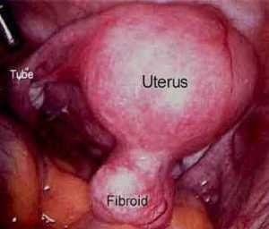 fibroid surgery courtesy of sflorg-com