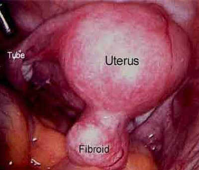 fibroid surgery courtesy of sflorg-com